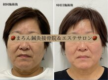 まろん鍼灸接骨院 立川店/小顔矯正コルギ＆美容鍼