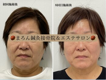 まろん鍼灸接骨院 立川店/小顔矯正コルギ＆美容鍼