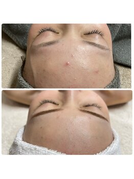 ヤワラ 長与店(yawara)/ハーブピーリング