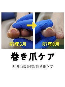 巻き爪ビフォーアフター