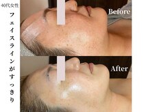 ヴィタベラ(Vita Bella)/WINBACKフェイシャル+ラミピ