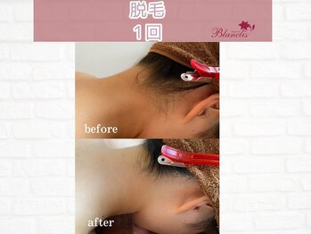 ブランリス(Blanclis)/全身脱毛☆効果