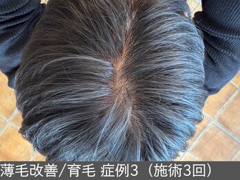 オアシスラグーン(OASIS LAGOON)/育毛促進(症例3施術3回)
