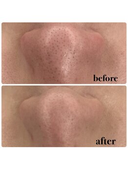 トイヴォ(TOIVO)の写真/眉毛ワックス×毛穴洗浄で清潔感アップ☆黒ずみや汚れを改善し、肌モテ男子へ導くメンズケアを◎