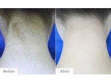 ティンクルホワイト 上尾店/うなじデザイン脱毛