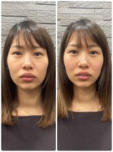 長寿鍼灸院 長寿整骨院/左右非対称のお顔に美容鍼★50本