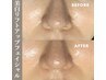 1日3組.口コミ限定！【毛穴角栓黒ずみスッキリコース】オープン特価1部位¥900