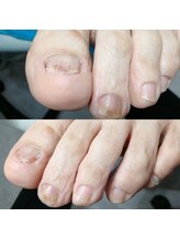 ドクターネイル爪革命 長野店/【肥厚・変形爪】ネイル/フット