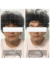 ダンニヒル(dannihil)/【小顔矯正】30代会社員2回目