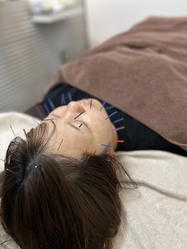 陽月 鍼灸院整骨院の写真/美容鍼で叶える究極の小顔ケア☆フェイスライン・まぶたの気になるたるみもしっかり改善・リフトアップ！
