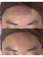 マリリン(MARILYN)/跡を残したくないニキビケアに♪