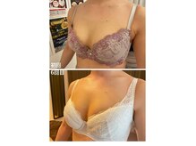 スマイルクルー(SmileClue)/ビフォーアフター症例