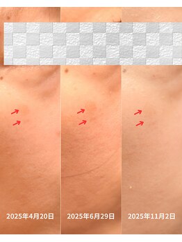 リビング(Living)/シミケアの経過(7ヶ月)