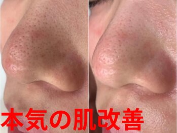 キング アンド クイーン 横浜青葉台店(KING&QUEEN)の写真/【30年の実績が証明｜男女OK 結果重視フェイシャル】結果にこだわる圧倒的施術力を是非ご体験下さい！！