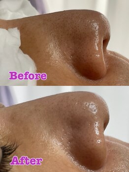 サンテ(Sante)/ハイドラフェイシャル×光フォト