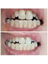 おうちサロン しゅろ/美容セルフホワイトニング