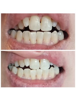 おうちサロン しゅろ/美容セルフホワイトニング