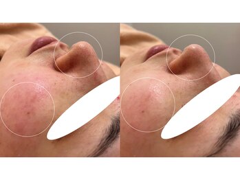 ミュー 春日井店(mieux)/◆肌質改善例