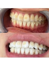 シエル 美里店(ciel)/ホワイトニング