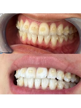 シエル 美里店(ciel)/ホワイトニング