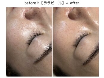 ベルティーク(BELTHEQUE)/ララピール＋IPL光フェイシャル