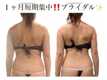 痩身革命 大宮店/ 施術写真（痩身）