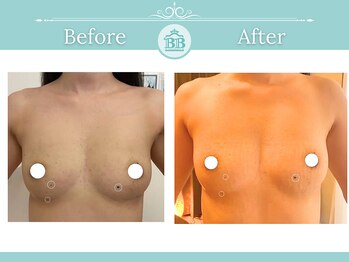 美人バスト 浜松店/◇ バストアップ &nbsp;BeforeAfter◇