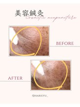 鍼灸院 ＨＡＲＩｅｙｕ/