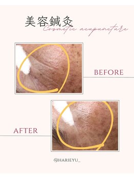 鍼灸院 ＨＡＲＩｅｙｕ/