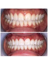 コナホワイトニング 神保町/セルフホワイトニング神保町