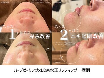 ルミエ 恵比寿店(Lumie)/ハーブピーリング&LDM 症例