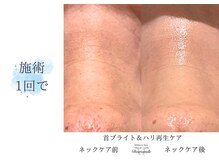 ディアスマイル(Dear.smile)/ネック施術1回で