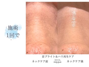 ディアスマイル(Dear.smile)/ネック施術1回で