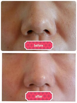 ソラ(Sola)/ビフォーアフター