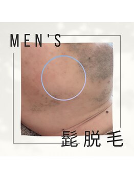 ハル ハロ(halu halo)/ヒゲ脱毛