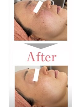 オウカ(OUKA)/ホワイトピールの症例