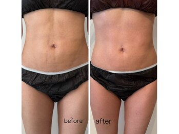 ラヴィ(La vie)/最新インディバ/ダイエット