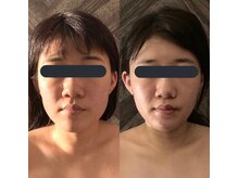 ハイコガオ(HIKOGAO)/小顔矯正60分