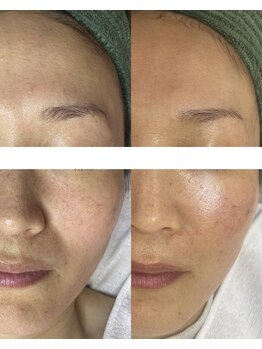 ティンクルホワイト 橿原店/最強の肌質改善にはプロセル