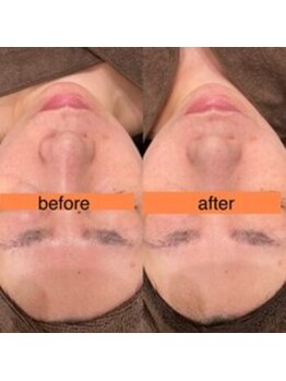 サクラ スパ(SAKURA SPA)/毛穴リメイクコース