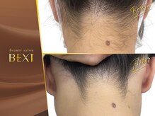 ベクスト(BEXT)/うなじ脱毛(PRO)