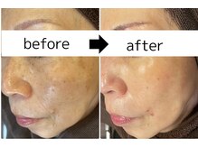 パールホワイトニングサロン 茅ヶ崎店/ホワイトニングケア