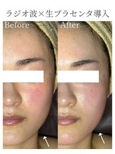 シストワ(sistoi)/落ちてきた肌代謝を上げるケア♪