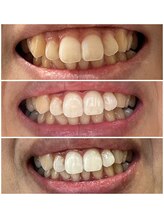 ボンダイボディー(Bondi Body)/セルフホワイトニング