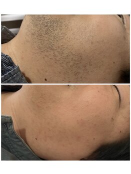 ラウレアサロン(laule'a salon)/ビフォー/アフタ-