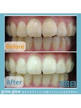 グロウ グロウ(grow.glow)/ホワイトニング調布仙川