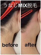 ロータス(Lotus)/ワックス&光脱毛のミックス脱毛