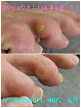 巻き爪じゅん 千葉駅前店/魚の目(ウオノメ)芯まで取れた！