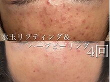 サロンヴェアリー 広尾(salon vary)の雰囲気（2か月集中悩み解消プラン！ニキビケアホワイト/跡ケアブラック）
