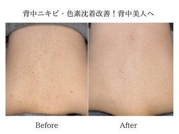 エミエル(EMIER)/ハーブピーリングBefore→After